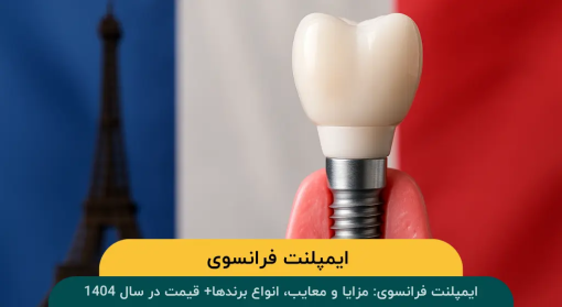 ایمپلنت-فرانسوی